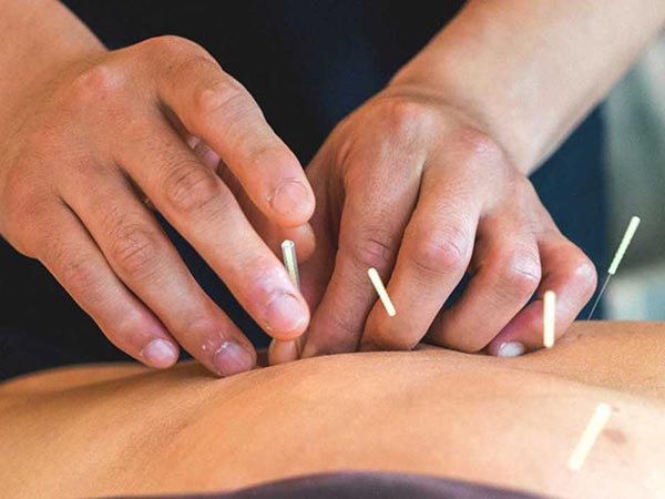 Acupuncture at Crawford Wellness in McMinnville, Oregon